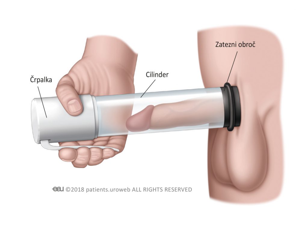 Fig. 1: A common type of vacuum erection device (VED).